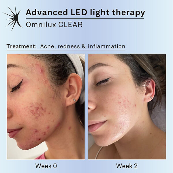 Light Therapy for Acne
